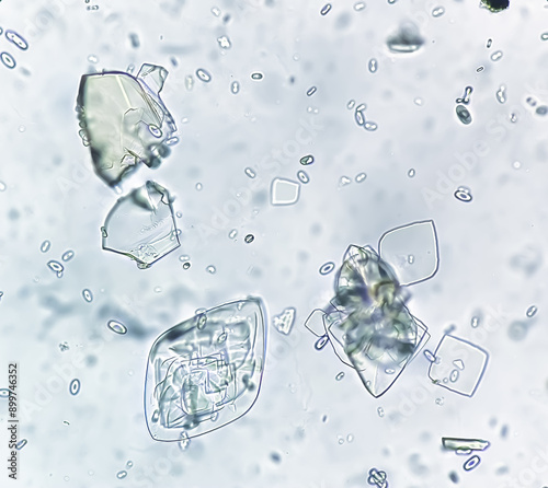 Uric acid crystals and calcium oxalate monohydrate under microscope