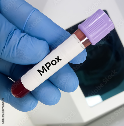 Blood test sample for monkey pox virus (MPXV) test at medical laboratory.