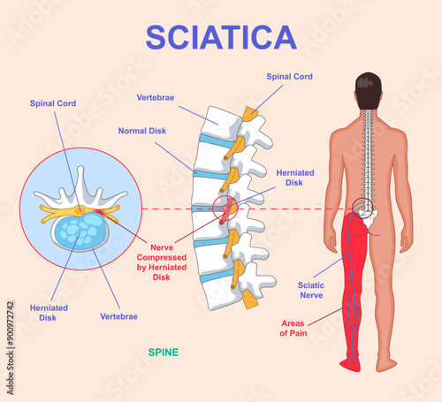 Sciatica medical diagram. Anatomical scheme with human spine, nerves and intervertebral disc. Infographic with sciatic nerve compression and leg pain. Hernia in lumbar spine. Flat vector illustration