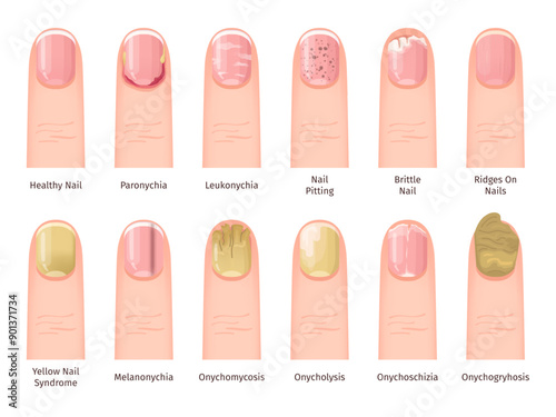 Nail Diseases. Health painful sickness or injured nails problem, fingernail infections conditions treatment medical dermatology diagnosis illness finger, swanky Vector Illustration