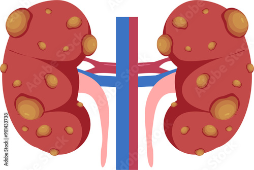 Kidney disease Illustration