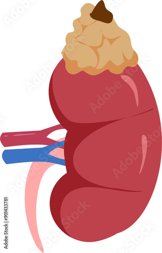 Kidney disease Illustration