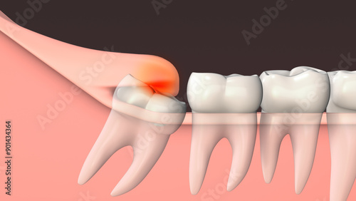 Inflammation of the gums due to an unerupted molar