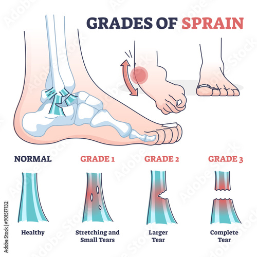 Grades of sprain as ankle or foot medical injury levels outline diagram, transparent background.Anatomical leg problem significance measurement and division illustration.