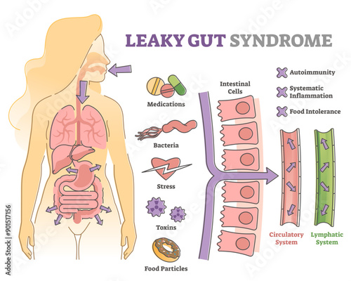 Leaky gut syndrome as immune system reaction to environment outline diagram, transparent background. Educational labeled scheme. photo