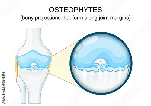 Osteophyte. Anatomy of human knee joint Osteoarthritis