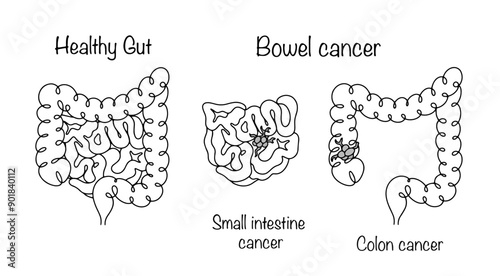 Bowel cancer
