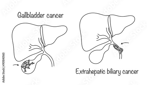 Gallbladder cancer