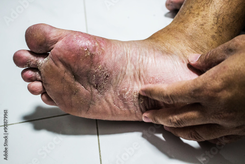 Men's feet with fungus, The skin peels off into wounds, Athlete's Foot, Tinea pedis, Fungal infection.
