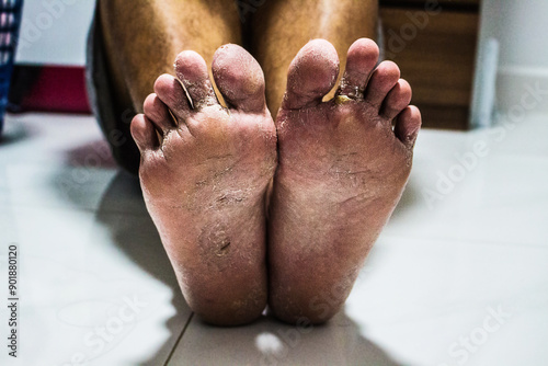 Men's feet with fungus, The skin peels off into wounds, Athlete's Foot, Tinea pedis, Fungal infection.