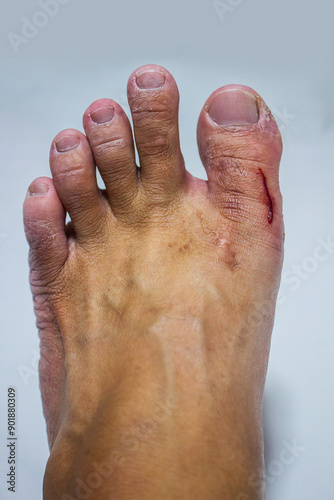 Injured foot with bleeding abrasion wound.