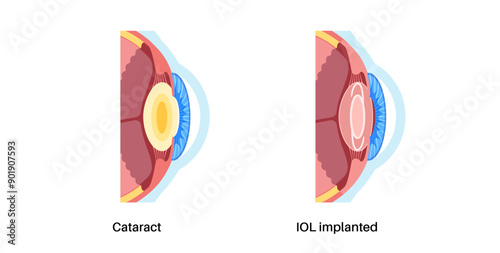 Intraocular lenses poster