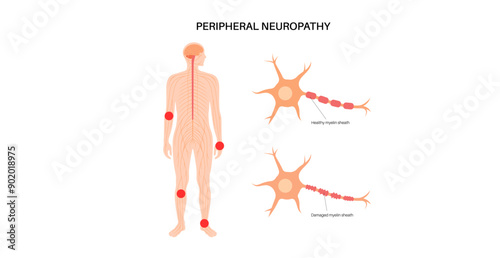 Peripheral neuropathy medical poster