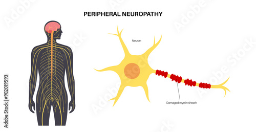 Peripheral neuropathy medical poster