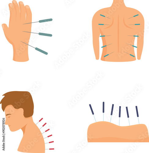 Illustration set of acupuncture therapy, a holistic. Natural. And ancient chinese medicine technique for pain relief. Relaxation. And rejuvenation. Using noninvasive. Therapeutic