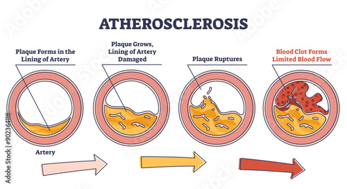 Atherosclerosis stages explanation and fatty plaque formation outline diagram, transparent background. Artery side view with limited blood flow and rupture risk illustration.