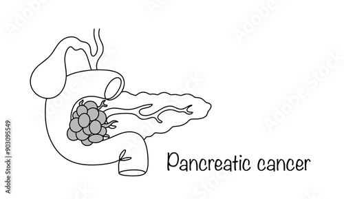 Pancreatic cancer