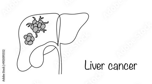Liver cancer