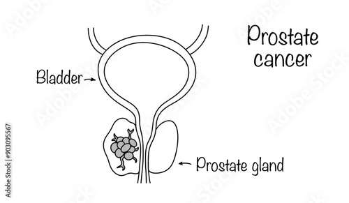 Prostate cancer