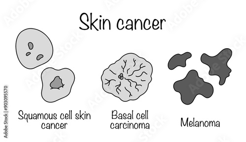 Skin cancer photo