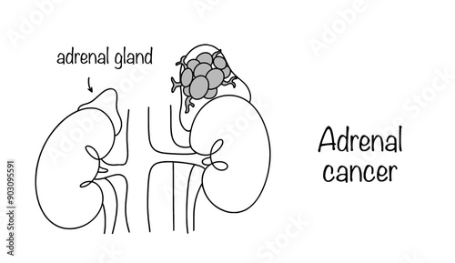Adrenal cancer