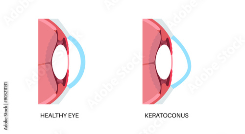 Cataract eye disease