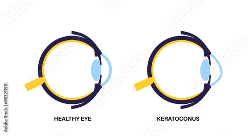 Cataract eye disease