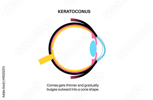 Cataract eye disease