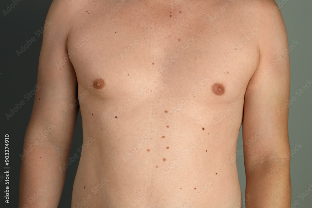 Man with birthmarks on his skin against grey background, closeup Man with birthmarks on his skin against grey background, closeup