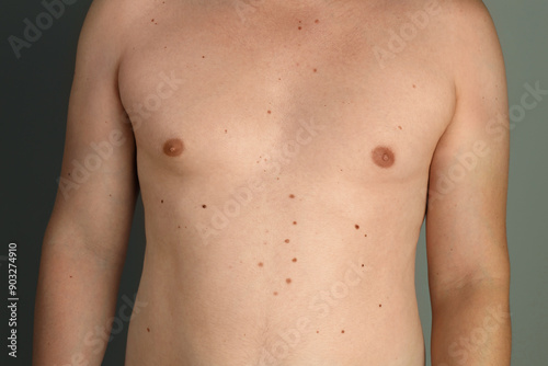 Man with birthmarks on his skin against grey background, closeup © New Africa