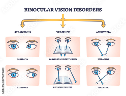 Binocular vision disorders with all eye defect examples outline diagram, transparent background. Labeled educational anatomical strabismus, vergence and amblyopia division illustration.