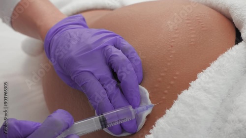 Aesthetic procedure for removing wrinkles on the buttocks with a syringe, performed by a professional. Procedure for removing stretch marks on the skin with injections in a cosmetic clinic