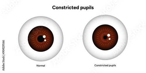 Constricted pupils eye diseases ophthalmology