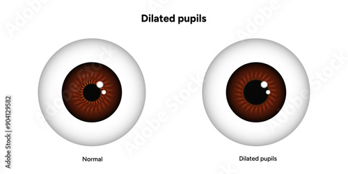 Dilated pupils eye diseases ophthalmology