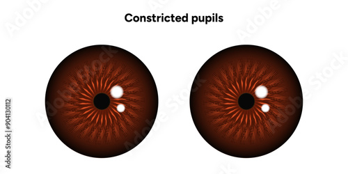 Constricted pupils eye diseases ophthalmology