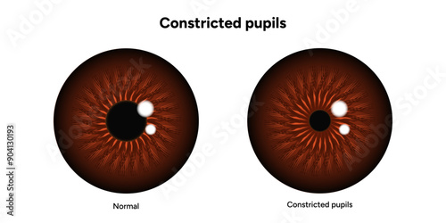 Constricted pupils eye diseases ophthalmology