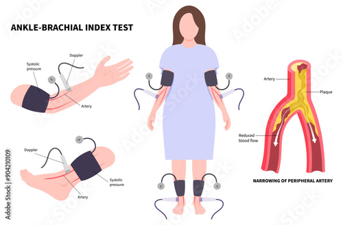 High blood pressure diagnosis and Foot ulcer with Peripheral artery disease of Leg veins clot fatty injury pain