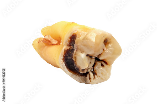 Removed wisdom tooth with caries isolated on a white background, close-up macro shot. Tooth number eight, highly detailed photo
