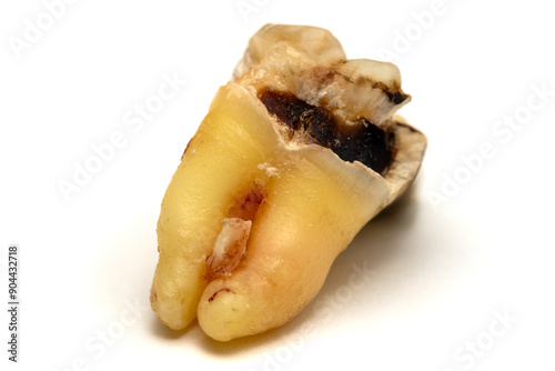 Removed wisdom tooth with caries isolated on a white background, close-up macro shot. Tooth number eight, highly detailed photo