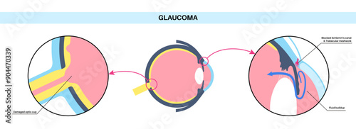 Glaucoma eye disease