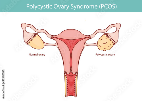 Polycystic ovary syndrome PCOS.  Ovarian cysts of the female reproductive system. New Year illustration is hand drawn.