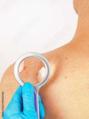 Skin examination by a dermatologist: examination of moles and formations to diagnose and evaluate the condition of the skin