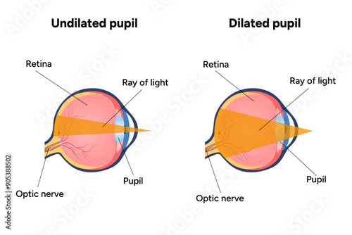 Eye anatomy with Dilated pupil and Undilated pupil 