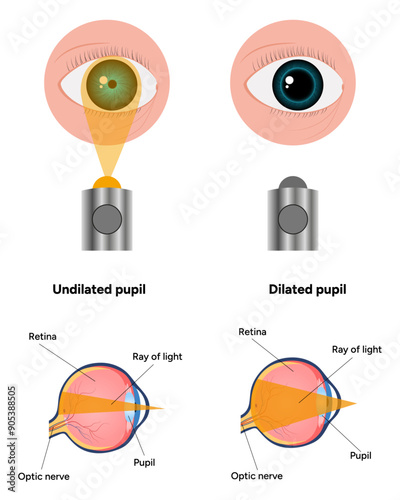 Pupil size in different lighting, Dilated pupil
and Undilated pupil  with Eye anatomy