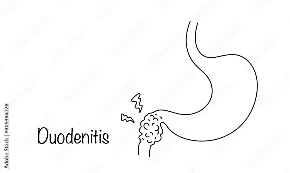 Fototapeta premium Duodenitis