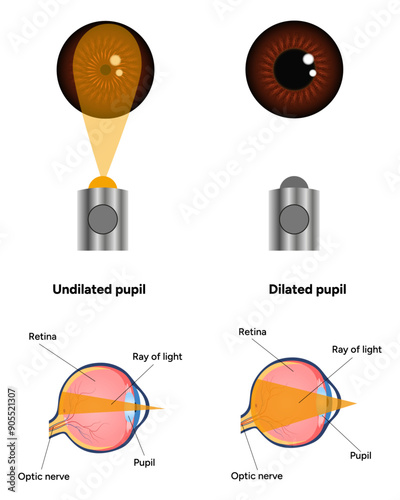 Pupil size in different lighting, Dilated pupil
and Undilated pupil  with Eye anatomy ophthalmology diagram 