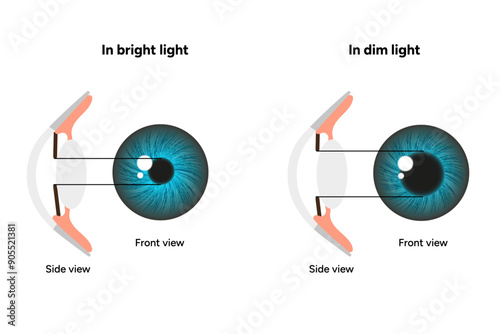 Pupil size in different lighting, Dilated pupil
and Undilated pupil  with ophthalmology diagram 