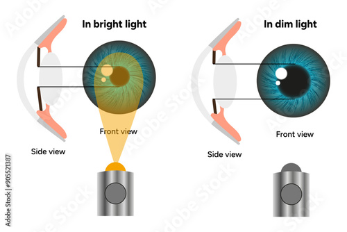 Pupil size in different lighting, Dilated pupil
and Undilated pupil  with ophthalmology diagram 
