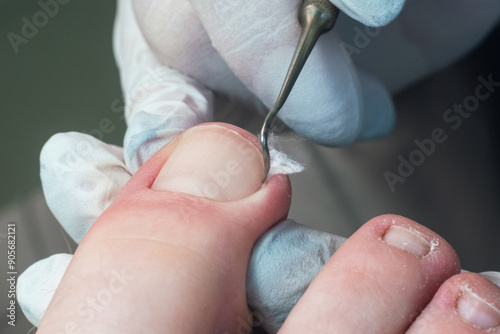 Medical pedicure, podiatrist doing tamponade to a deformed toenail photo