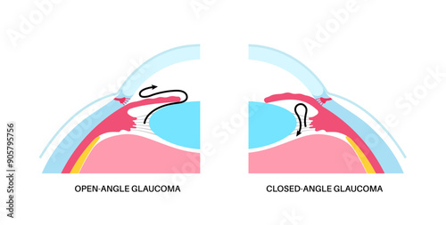 Glaucoma eye disease
